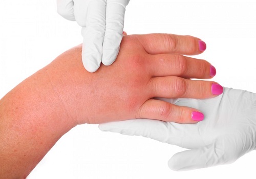 List Of Some Common Allergic Reactions