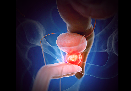 Lifestyle Changes Can Cure Benign Prostatic Hyperplasia