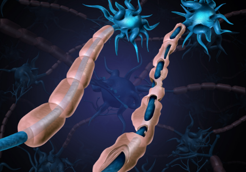 All You Need To Know About Multiple Sclerosis