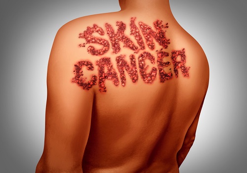 Understanding Skin Cancer And Its types
